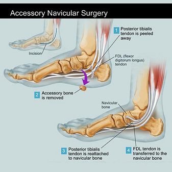 Accessory Navicular Syndrome  Foot & Ankle Specialty Group